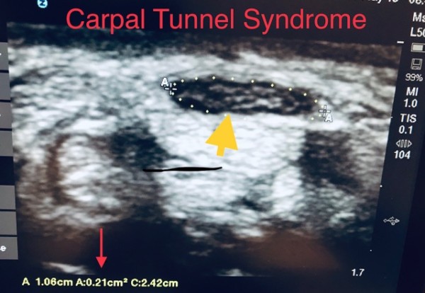 Ultrasound Our Preferred Test For Diagnosing Carpal Tunnel Syndrome
